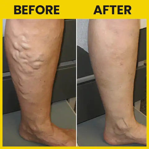 Relief Patches For Varicose Spider Veins